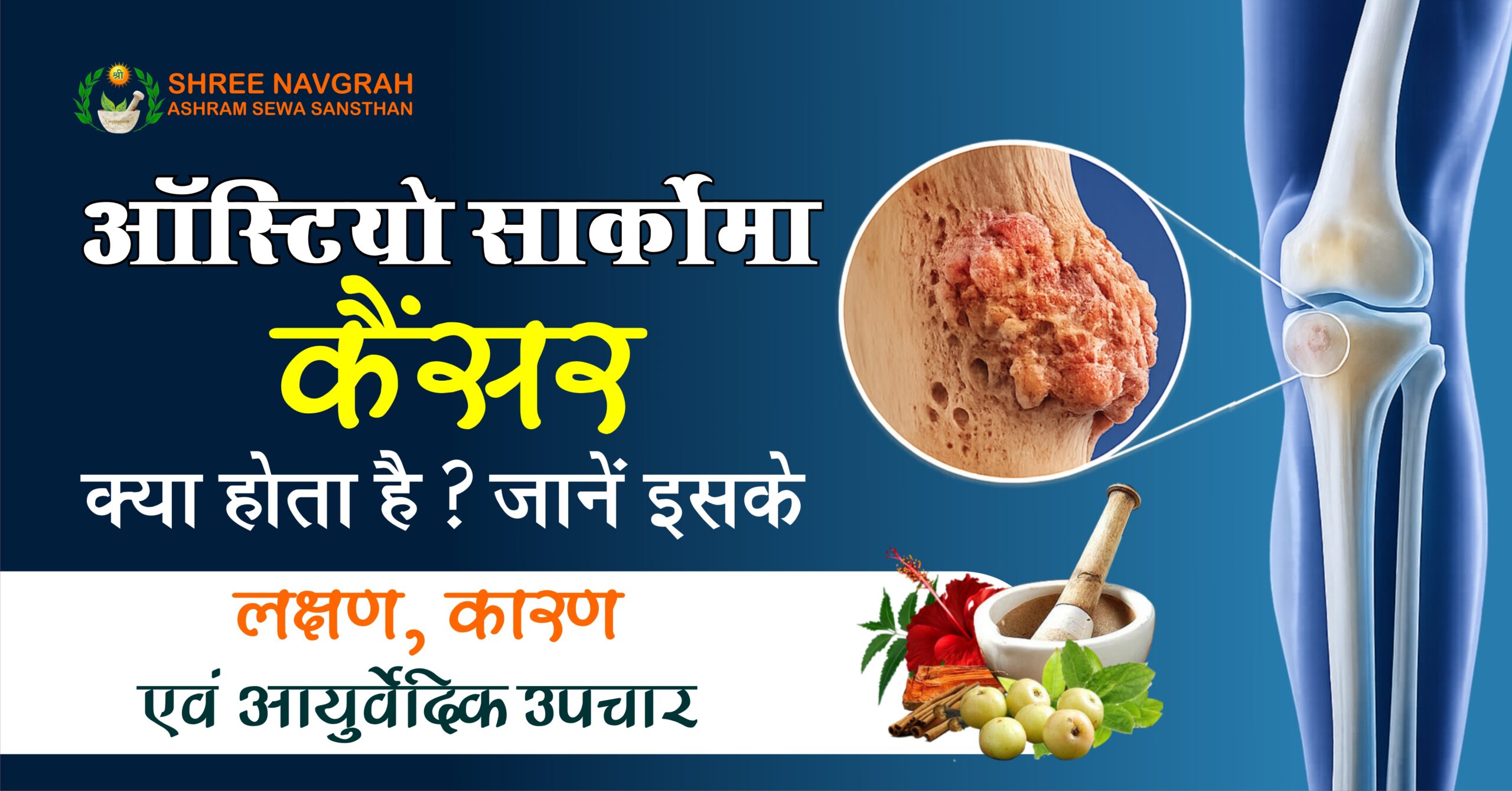 Osteosarcoma (Bone Cancer) medical illustration showing a bone tumor near the knee | Shree Navgrah Aashram Sewa Sansthan